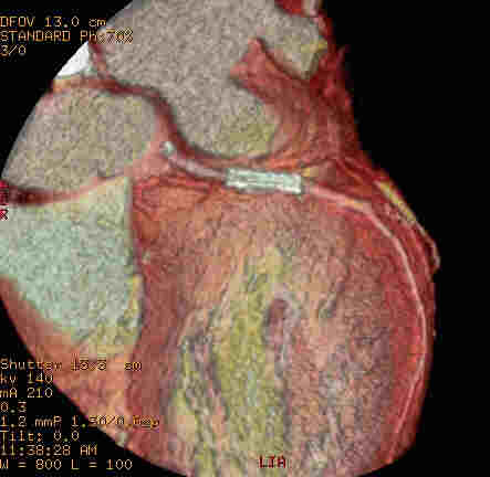 circonflessa stent